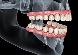 man smiling after getting all-on-4 dental implants