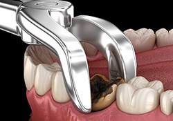 A 3D illustration of the tooth extraction process