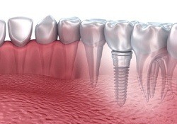 single dental implant post in the jaw