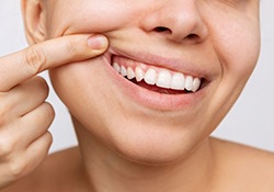 Woman pulling back her cheek to show her healthy gums