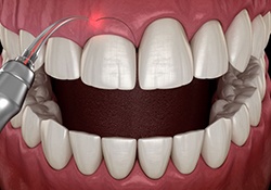 Illustration of laser being used during gum recontouring