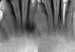 x-ray of tooth root