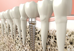 Digital illustration of a dental implant